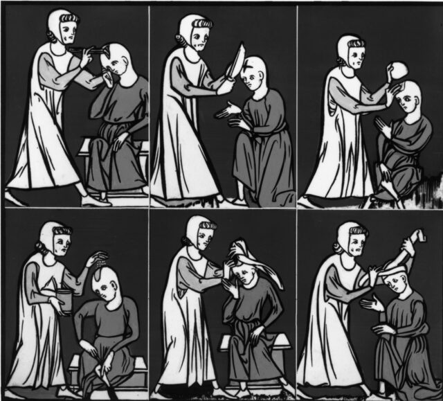 An illustration of the steps of trepanning.